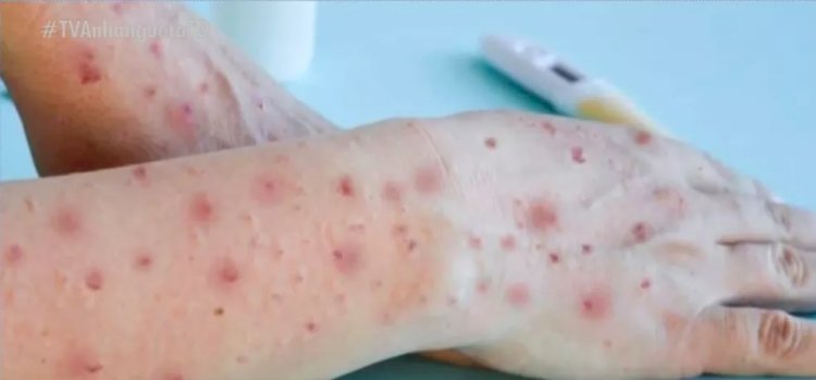 Saúde  Crianças infectadas por varíola dos macacos na cidade de SP têm entre 4 e 6 anos, diz Prefeitura