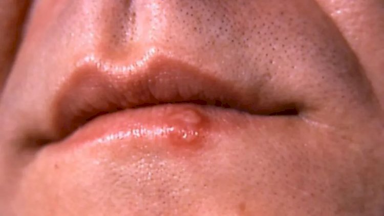 Pesquisa liga beijos na Idade do Bronze a origem da herpes labial