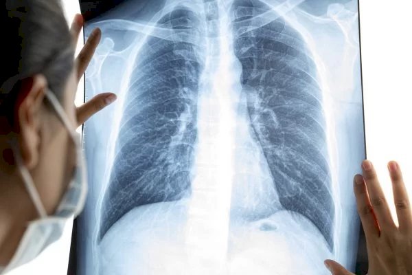 Programa de computador pode prever câncer de pulmão 10 anos antes