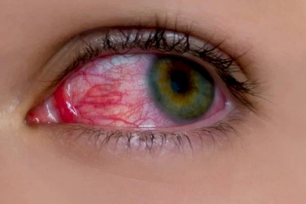 Olho irritado: nova variante da Covid, Arcturus tem sintoma particular