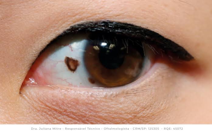 Estudo alerta para melanoma que pode surgir nos olhos e em outras regiões fora da pele